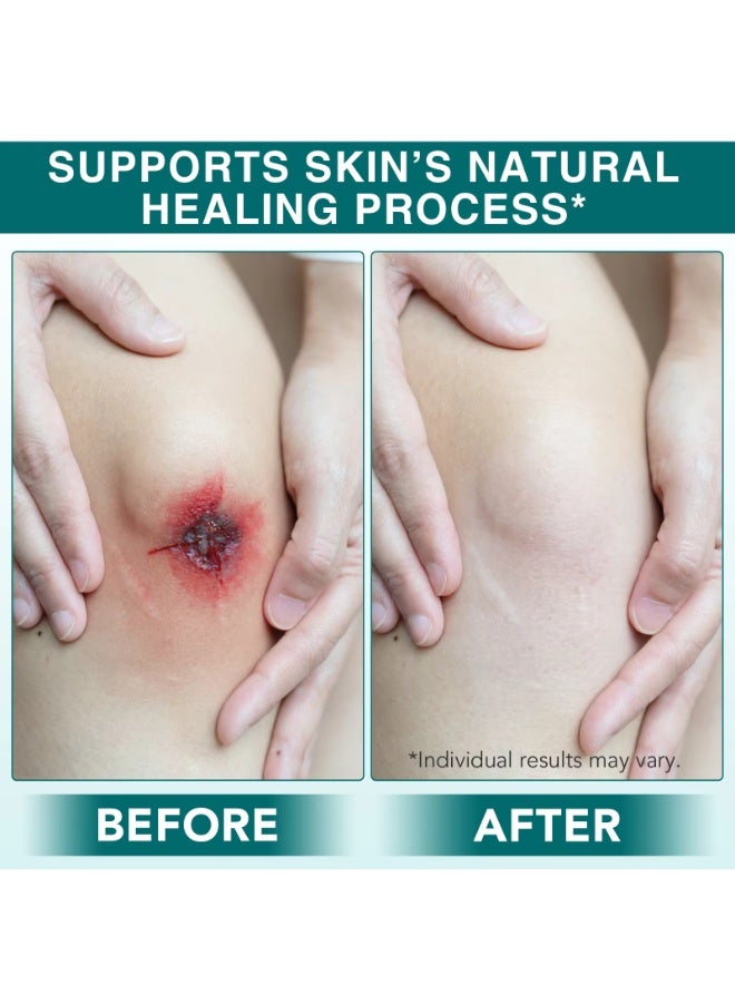 Elaimei Medical Grade Hydrocolloid Dressing Roll for Wound Care Supports Natural Healing Ultra Absorbent Reduces Friction Breathable Home Essential Hydrocolloid Roll Advanced Wound Bandages 5cmx3.6m - Image 2